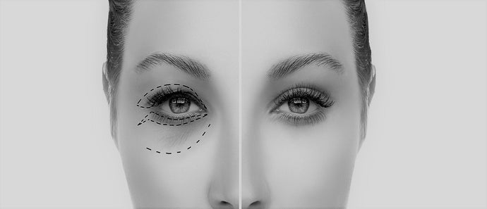 Eyelid Reduction (Blepharoplasty)